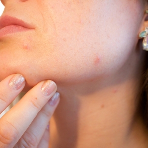 Foods that may be causing your Acne