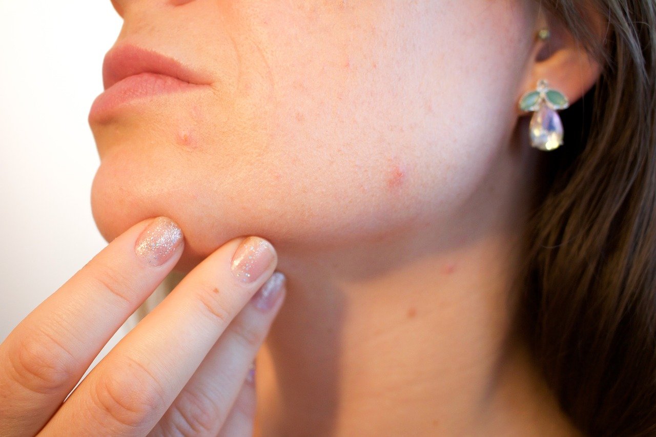 Foods that may be causing your Acne