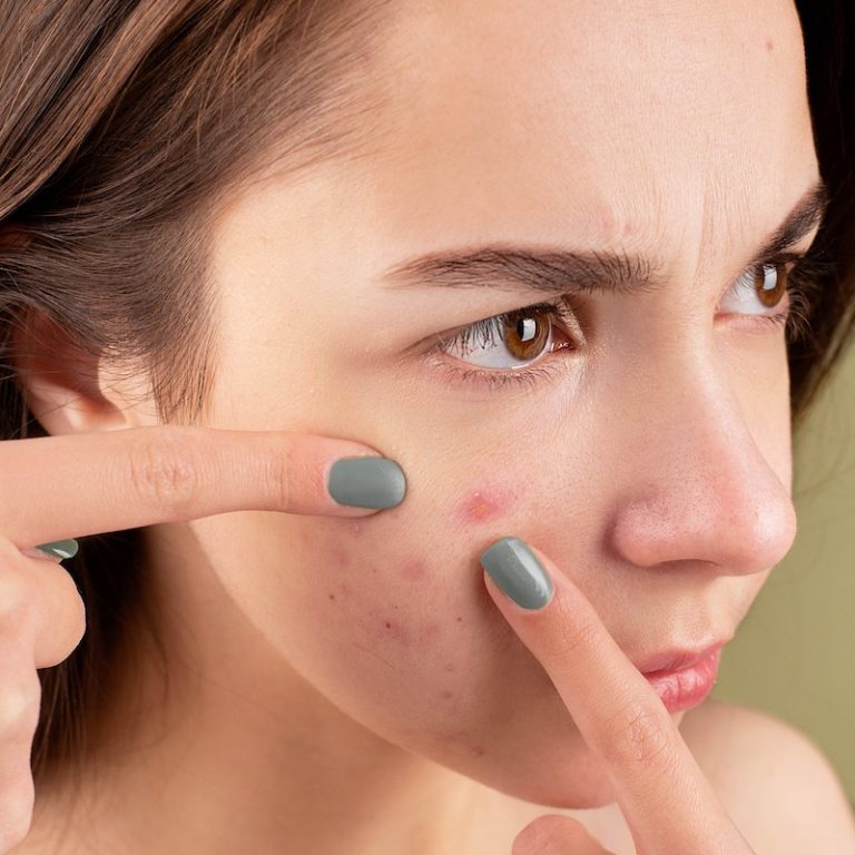 Woman Squeezing Her Pimples with Her Fingers